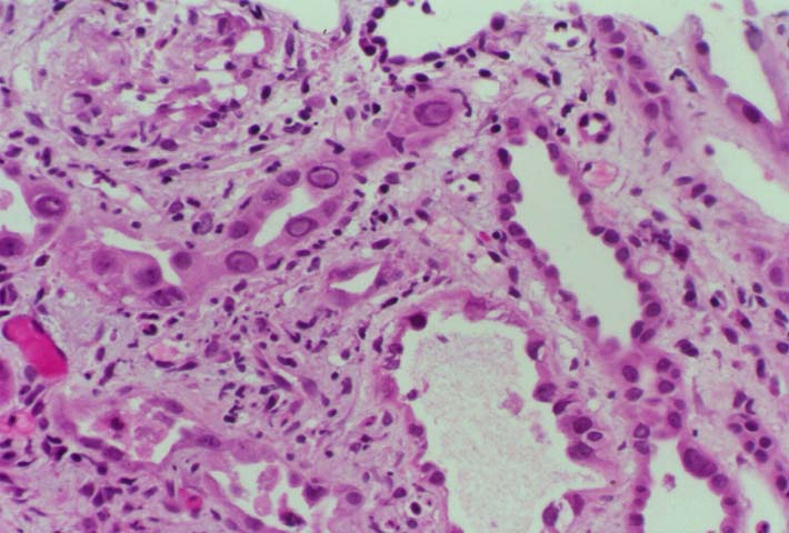 Acute Interstitial 
Nephritis