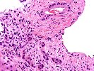 Ductular proliferation/ Cytoplasmic eosinophilia