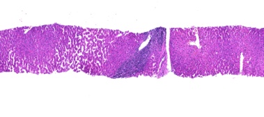 Patchy confluent necrosis and inflammation