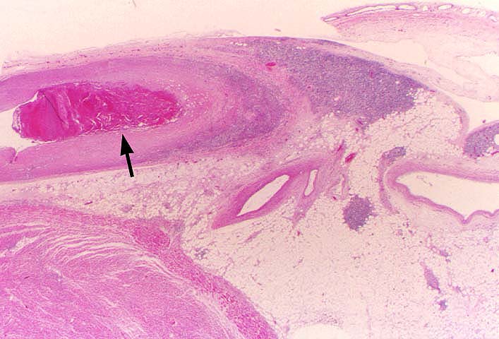 Obliterative Arteriopathy