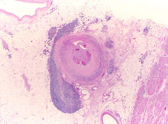 Obliterative Arteriopathy