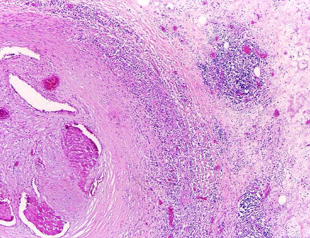 Obliterative Arteriopathy