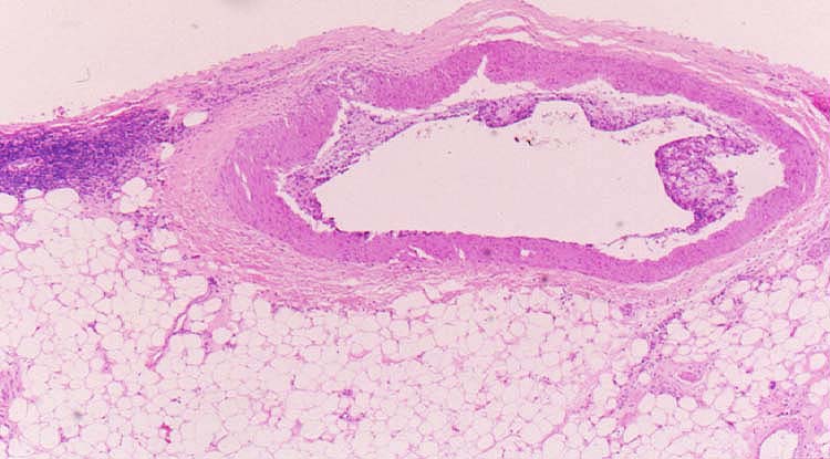 Obliterative Arteriopathy