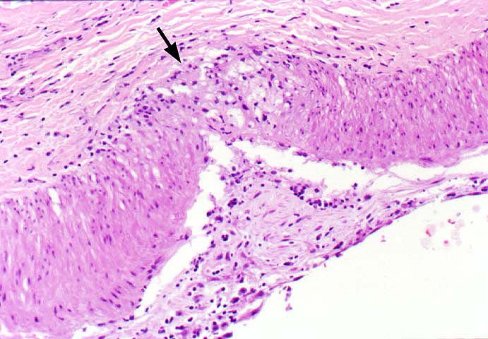 Obliterative Arteriopathy