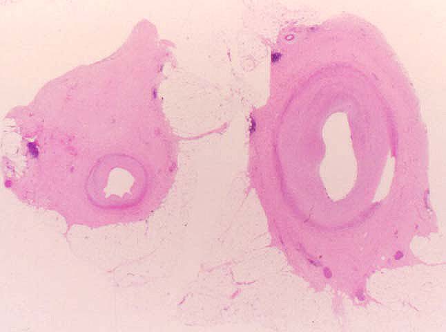 Obliterative Arteriopathy