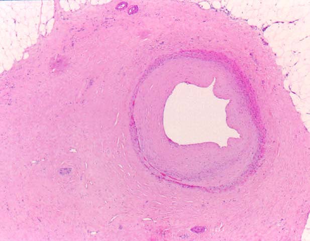 Obliterative Arteriopathy