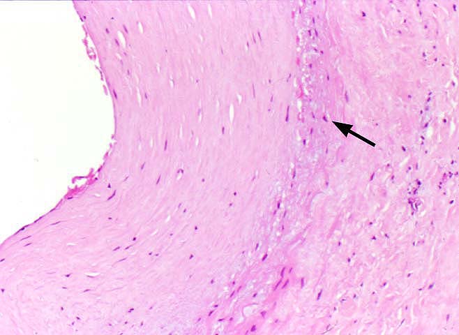 Obliterative Arteriopathy