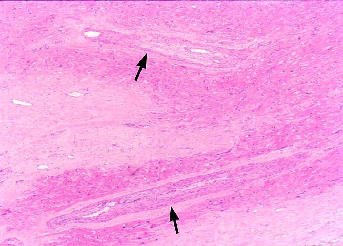 Obliterative Arteriopathy