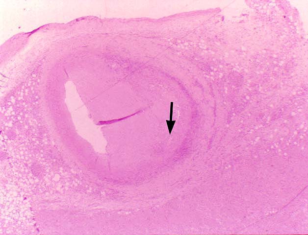 Obliterative Arteriopathy