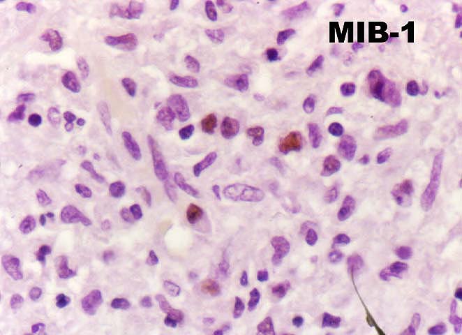 Obliterative Arteriopathy