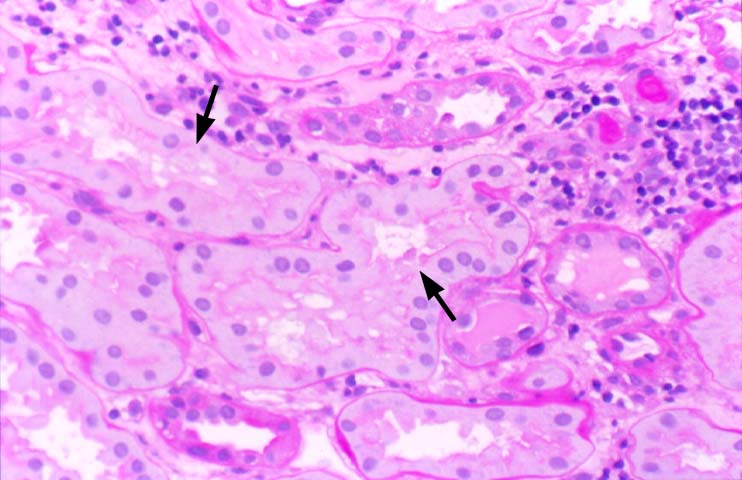 coagulative necrosis kidney