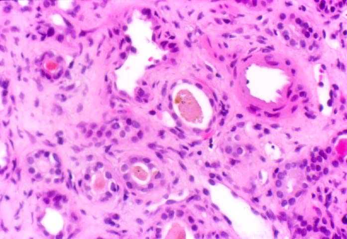 Acute Tubular Necrosis Histology