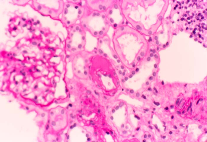 hyaline arteriolosclerosis