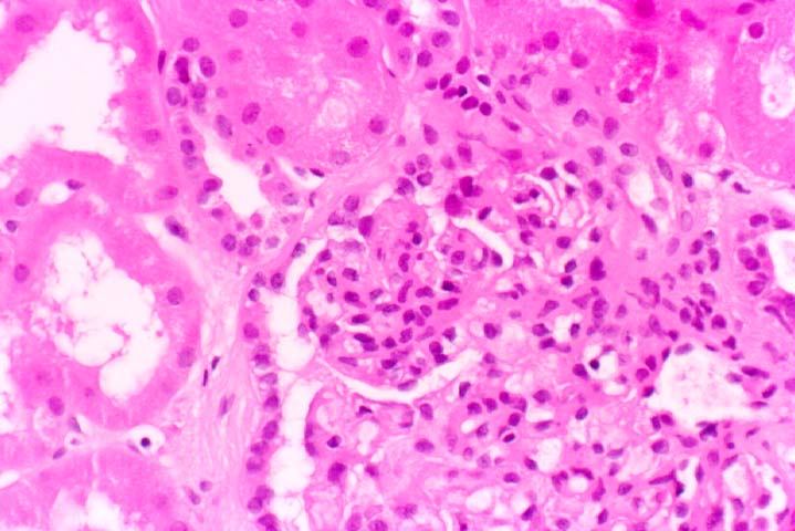 Chronic Transplant 
                         Glomerulopathy