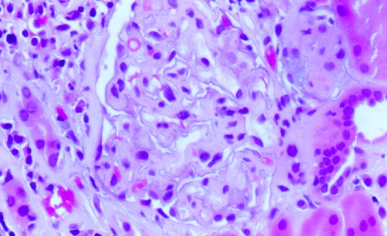 Chronic Transplant 
Glomerulopathy