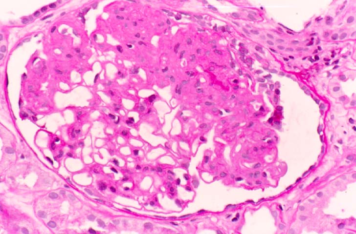 Chronic Transplant 
Glomerulopathy