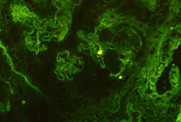 Chronic Transplant 
                         Glomerulopathy