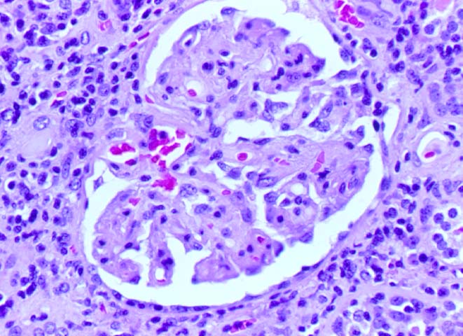 Ischemic 
                         Glomerulopathy