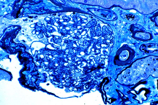 Ischemic Glomerulopathy