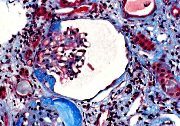 Ischemic Glomerulopathy