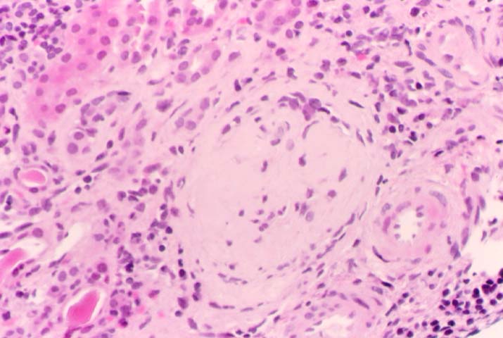 Ischemic Glomerulopathy