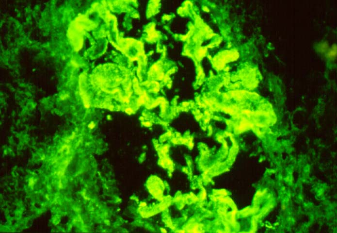 Ischemic Glomerulopathy