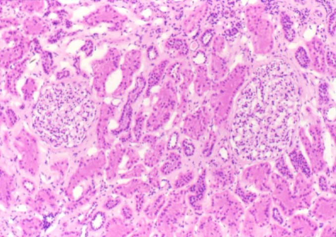 Chronic Interstitial 
Fibrosis