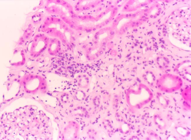 Chronic Interstitial 
                         Fibrosis