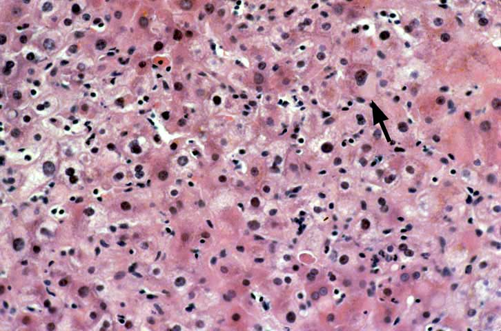 hepatitis b liver histology