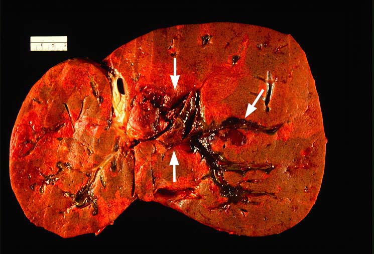 Vascular Thrombosis