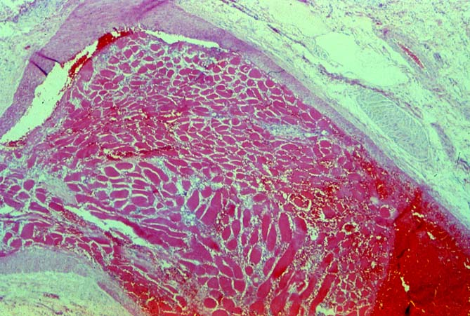 Vascular Thrombosis