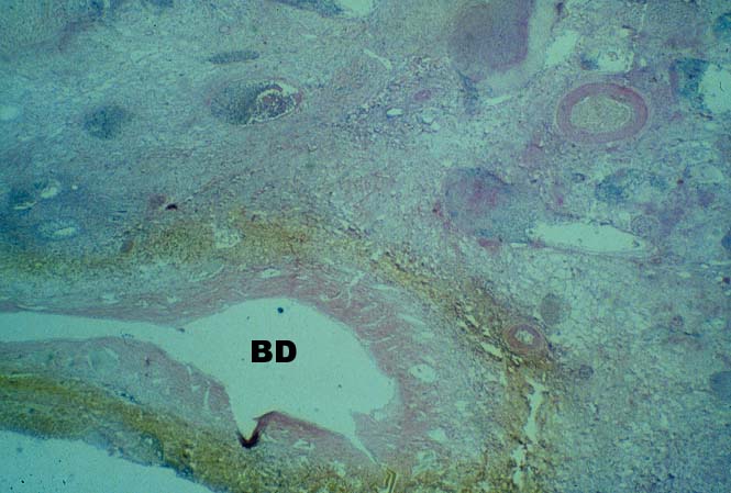 Vascular Thrombosis