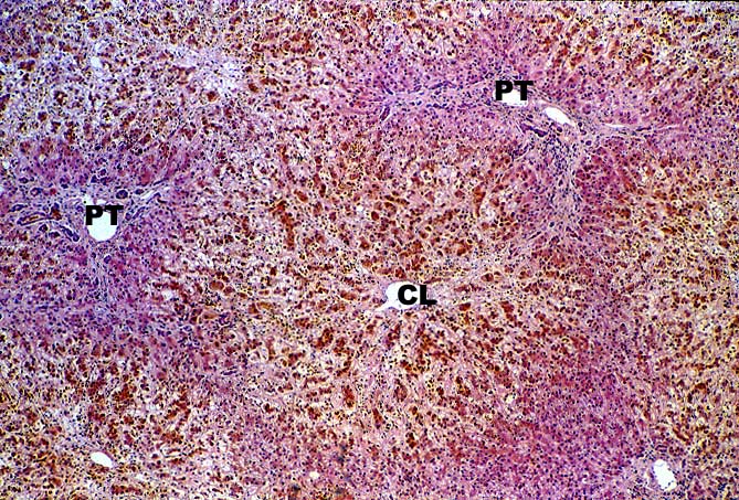 Vascular Thrombosis