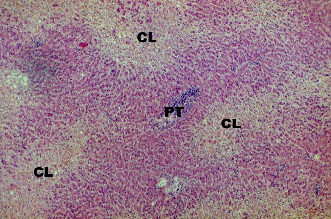 Vascular Thrombosis