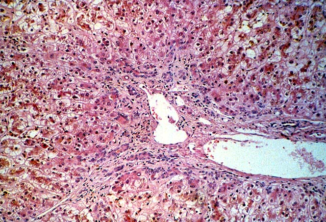 Vascular Thrombosis