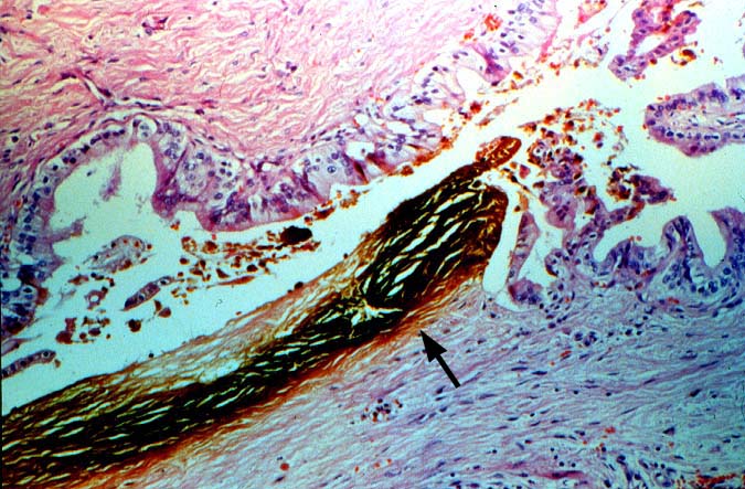 Vascular Thrombosis