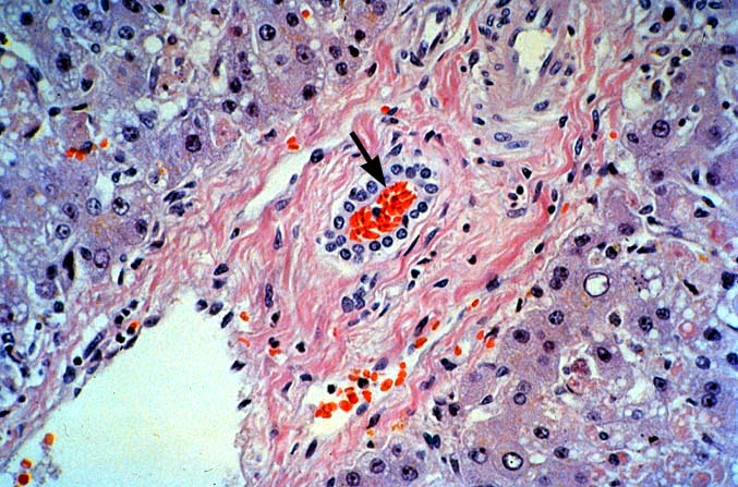 Biliary Tract Complications