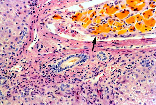 Biliary Tract Complications