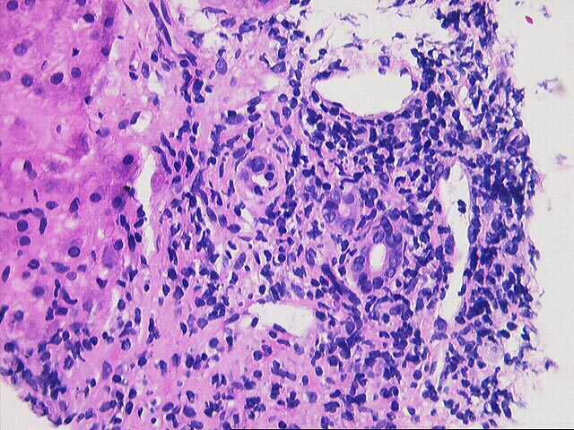 Allograft Liver, Needle Biopsy - Case 57