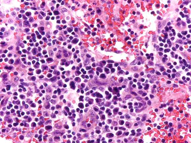 Plasma cell hyperplasia