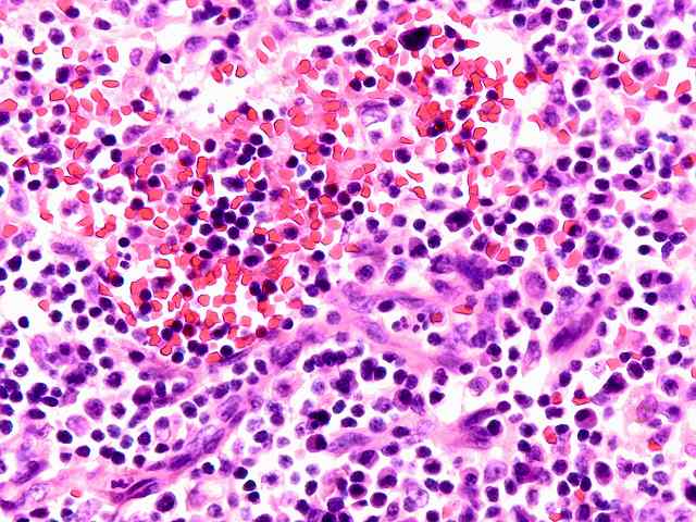 Plasma cell hyperplasia