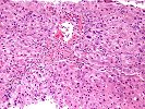 Centrilobular inflammation/ Hemorrhage