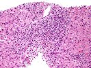 Ductular proliferation/ Biliary epithelial changes