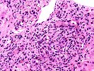 Ductular proliferation/ Biliary epithelial changes