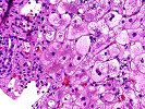 Cholestasis/Foam cells/Autoimmune hepatitis