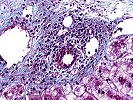 Focal lymphocytic cholangitis